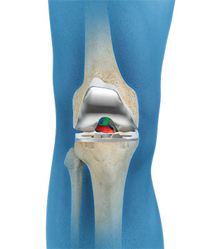 ACL Preserving Total Knee Replacement