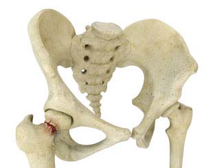 Periprosthetic Hip Fractures