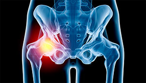 Hip Injury