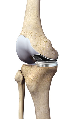 Partial Medial Knee Replacement