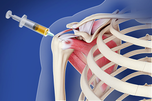 Platelet-Rich Plasma (PRP)