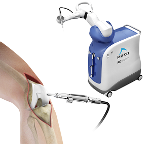 Robotic Assisted Partial Knee Surgery