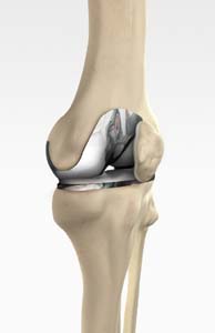 Tricompartmental Knee Replacement